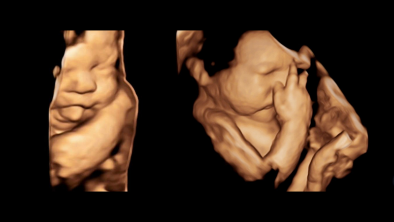 3d-4d; 4D baby ultrasounds