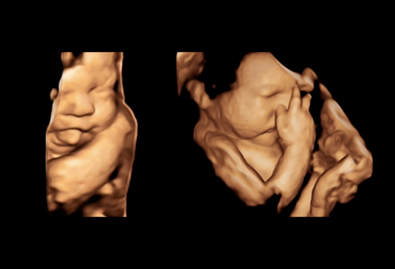 3d-4d; 4D baby ultrasounds