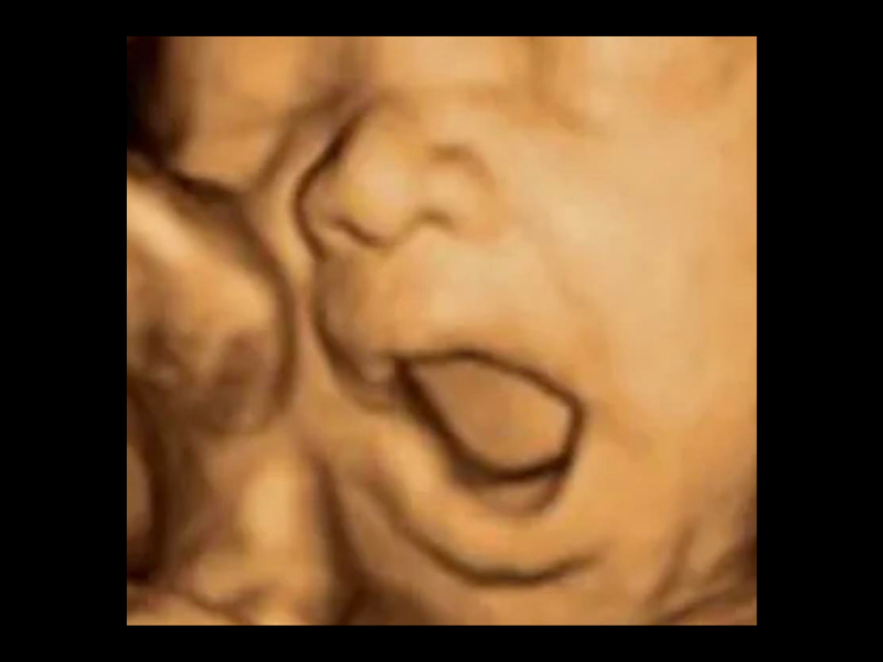 3d-ultrasound; 3D baby ultrasound