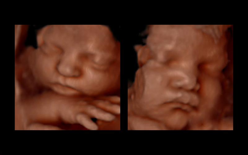 hd ultrasounds